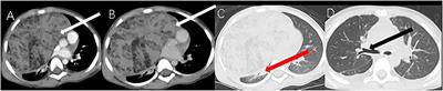 Case report: Imaging findings of true thymic hyperplasia at 18F-FDG PET/CT in an infant